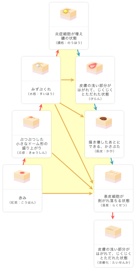 湿疹三角形とは